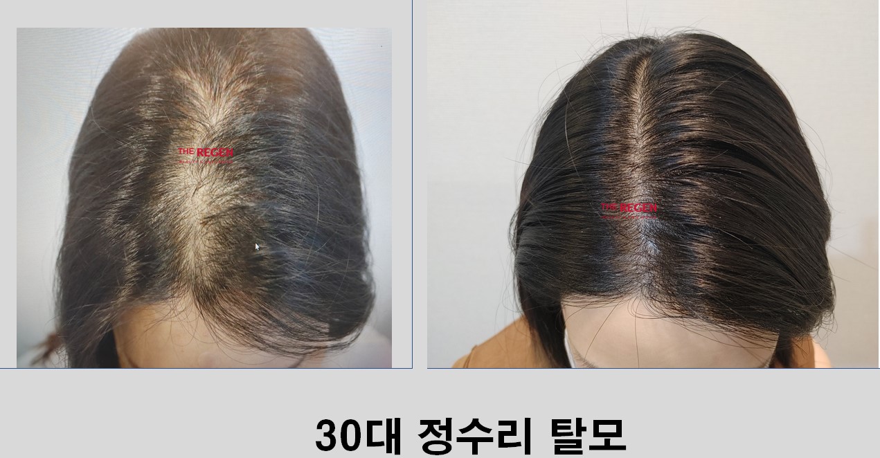 30대 정수리탈모 before after